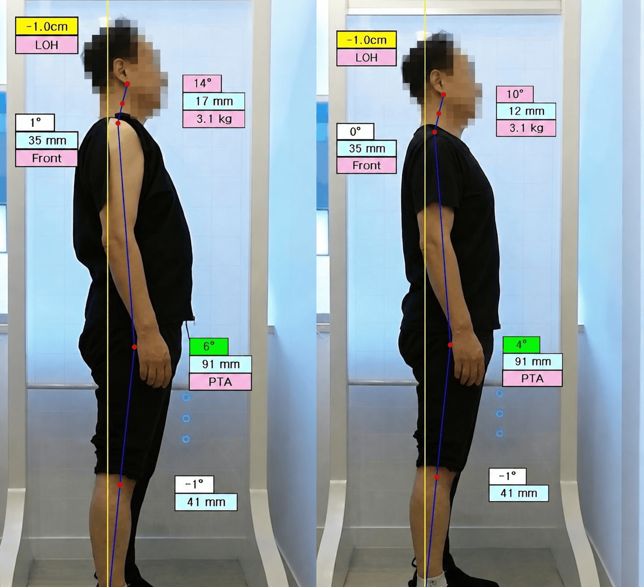 골타추나 치료 사례1 체형 사진