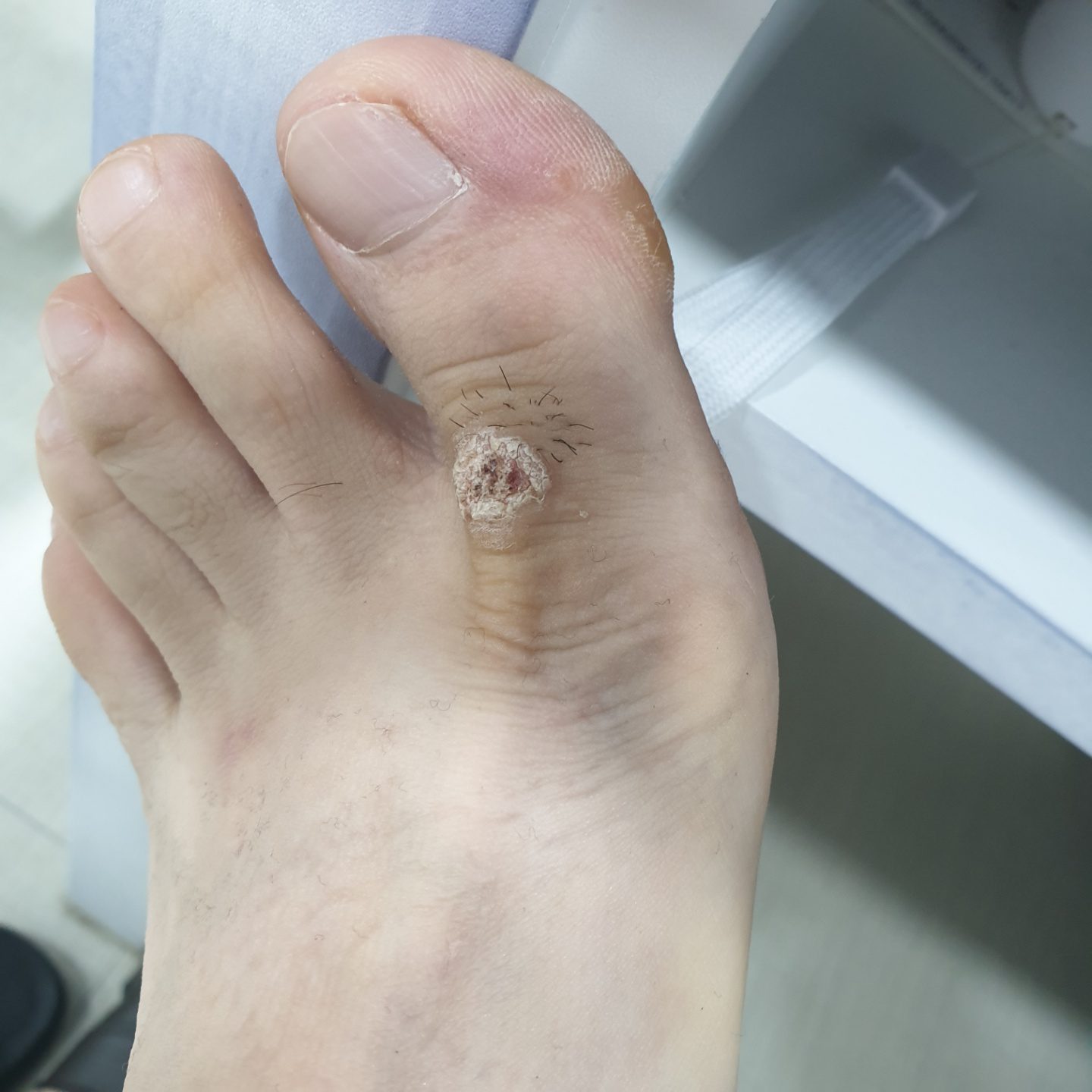 사마귀 치료 전 - 처음 내원 시 상태 사진 1