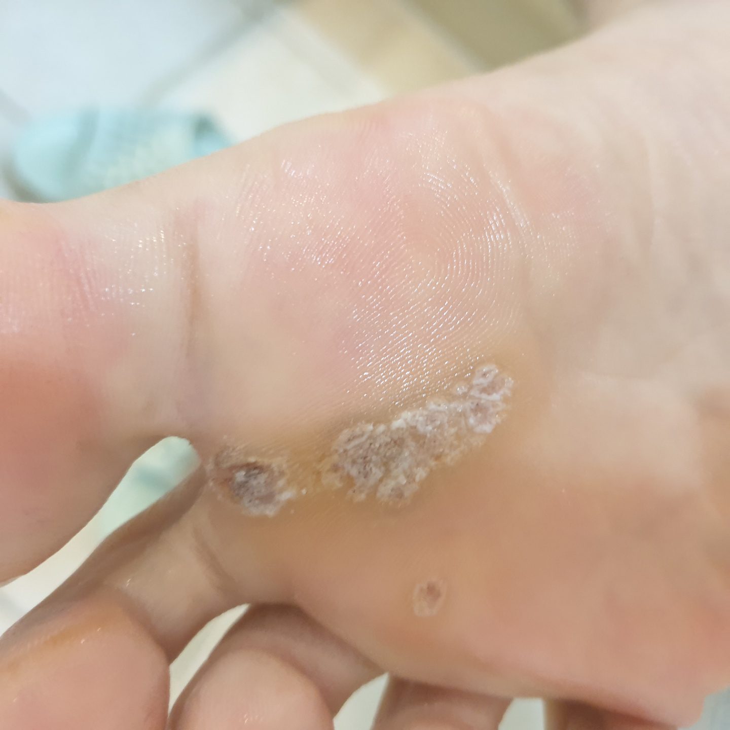 사마귀 치료 3~4주차 경과 사진 2