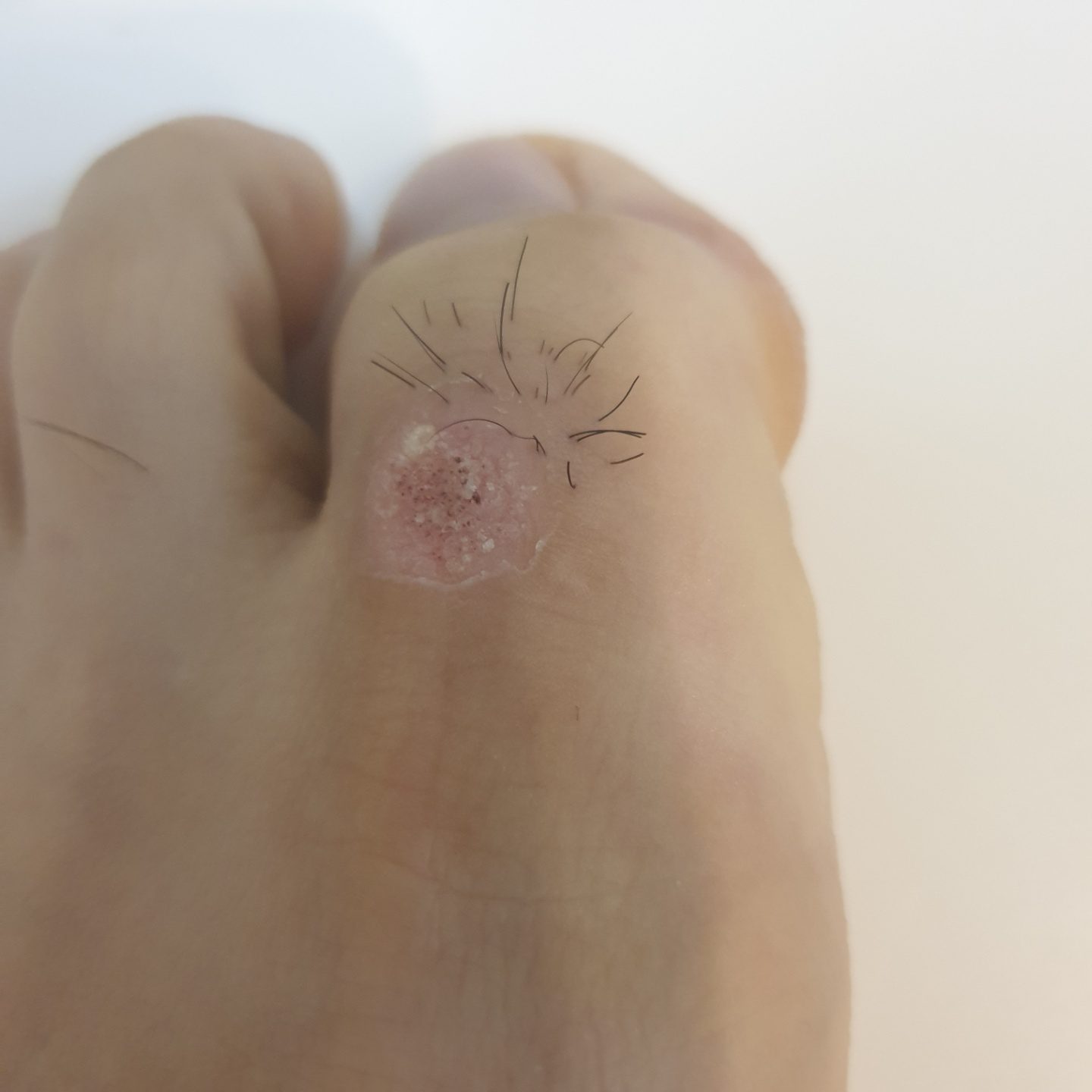 사마귀 치료 3~4주차 경과 사진 1