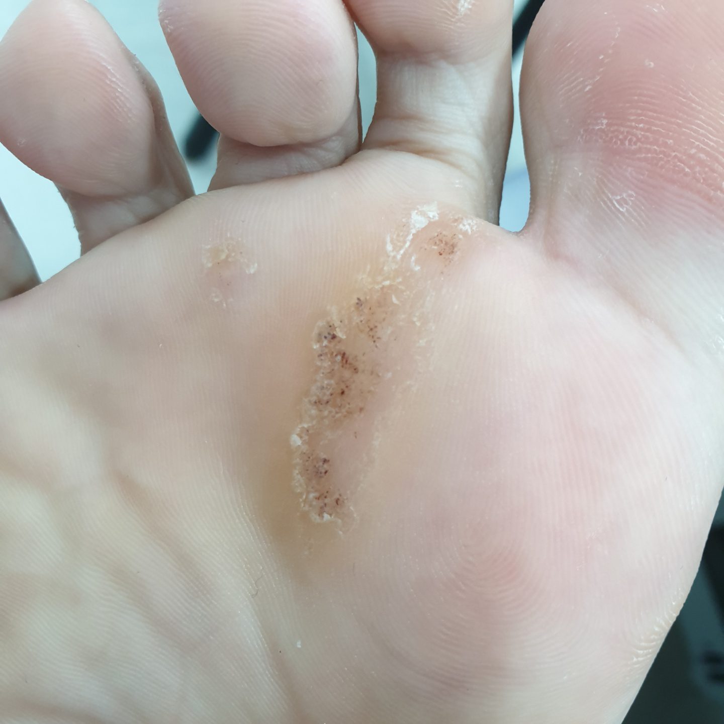 사마귀 치료 마지막 경과 사진 2